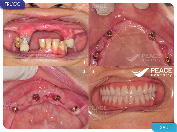 Hình Ảnh Implant: Quy Trình Chi Tiết & Kết Quả Trước‑sau Cho Người Mới Tìm Hiểu