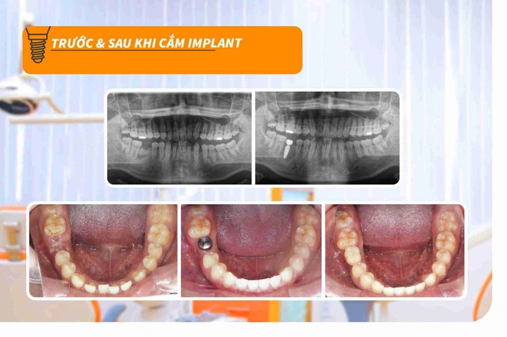 Hình Ảnh Implant: Quy Trình Chi Tiết & Kết Quả Trước‑sau Cho Người Mới Tìm Hiểu