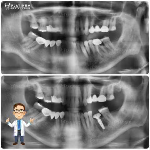 Hình Ảnh Implant: Quy Trình Chi Tiết & Kết Quả Trước‑sau Cho Người Mới Tìm Hiểu