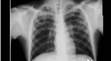 Giải Mã Ý Nghĩa Bệnh Lý Hình Ảnh Kính Mờ Trên Phim Ct/x-quang Và Phân Biệt Với Nốt Mờ Phổi Giải Mã Ý Nghĩa Bệnh Lý Hình Ảnh Kính Mờ Trên Phim Ct/x-quang Và Phân Biệt Với Nốt Mờ Phổi