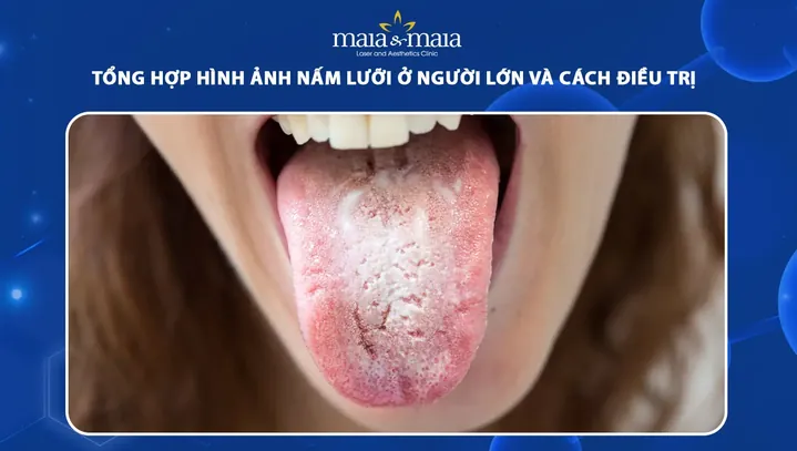 Xem Hình Ảnh Lưỡi Người Bình Thường Và Bệnh Lý Cho Mọi Người Để Nhận Diện Xem Hình Ảnh Lưỡi Người Bình Thường Và Bệnh Lý Cho Mọi Người Để Nhận Diện