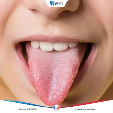 Xem Hình Ảnh Lưỡi Người Bình Thường Và Bệnh Lý Cho Mọi Người Để Nhận Diện Xem Hình Ảnh Lưỡi Người Bình Thường Và Bệnh Lý Cho Mọi Người Để Nhận Diện