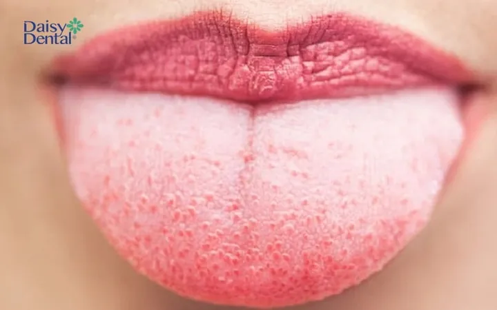 Xem Hình Ảnh Lưỡi Người Bình Thường Và Bệnh Lý Cho Mọi Người Để Nhận Diện Xem Hình Ảnh Lưỡi Người Bình Thường Và Bệnh Lý Cho Mọi Người Để Nhận Diện