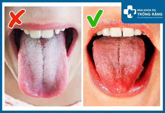 Xem Hình Ảnh Lưỡi Người Bình Thường Và Bệnh Lý Cho Mọi Người Để Nhận Diện Xem Hình Ảnh Lưỡi Người Bình Thường Và Bệnh Lý Cho Mọi Người Để Nhận Diện
