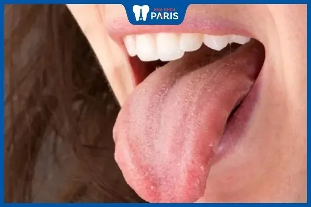Xem Hình Ảnh Lưỡi Người Bình Thường Và Bệnh Lý Cho Mọi Người Để Nhận Diện Xem Hình Ảnh Lưỡi Người Bình Thường Và Bệnh Lý Cho Mọi Người Để Nhận Diện