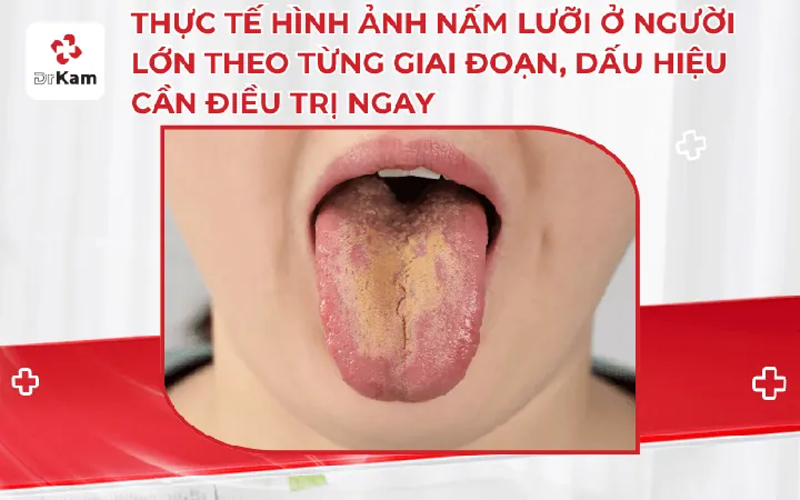 Xem Hình Ảnh Lưỡi Người Bình Thường Và Bệnh Lý Cho Mọi Người Để Nhận Diện Xem Hình Ảnh Lưỡi Người Bình Thường Và Bệnh Lý Cho Mọi Người Để Nhận Diện