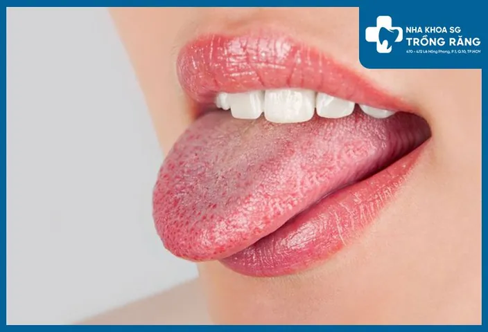 Xem Hình Ảnh Lưỡi Người Bình Thường Và Bệnh Lý Cho Mọi Người Để Nhận Diện Xem Hình Ảnh Lưỡi Người Bình Thường Và Bệnh Lý Cho Mọi Người Để Nhận Diện