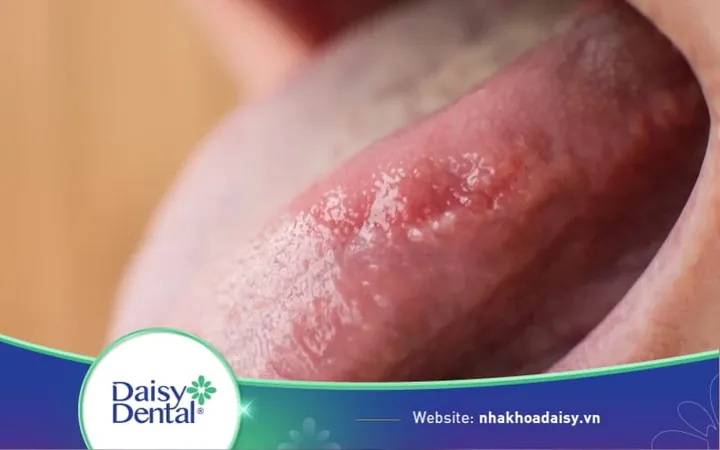 Xem Hình Ảnh Lưỡi Người Bình Thường Và Bệnh Lý Cho Mọi Người Để Nhận Diện Xem Hình Ảnh Lưỡi Người Bình Thường Và Bệnh Lý Cho Mọi Người Để Nhận Diện
