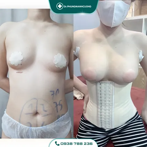 Xem Hình Ảnh Thực Tế Nâng Ngực Của Chị Em Trước Sau Phẫu Thuật
