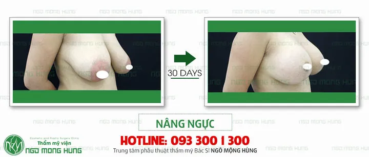 Xem Hình Ảnh Thực Tế Nâng Ngực Của Chị Em Trước Sau Phẫu Thuật