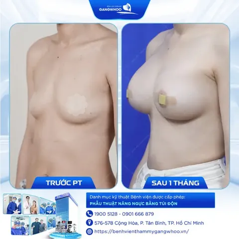 Xem Hình Ảnh Thực Tế Nâng Ngực Của Chị Em Trước Sau Phẫu Thuật