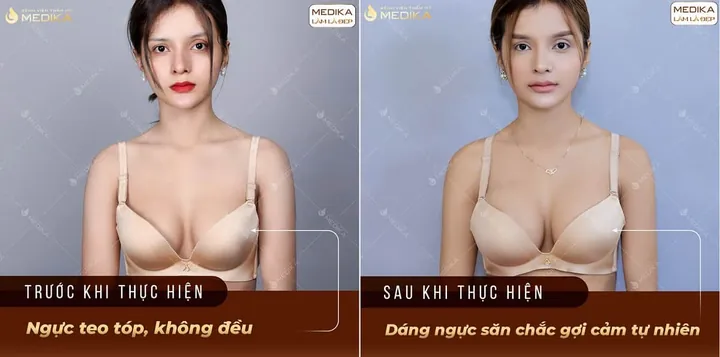Xem Hình Ảnh Thực Tế Nâng Ngực Của Chị Em Trước Sau Phẫu Thuật