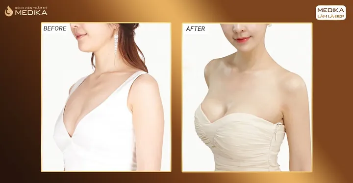 Xem Hình Ảnh Thực Tế Nâng Ngực Của Chị Em Trước Sau Phẫu Thuật