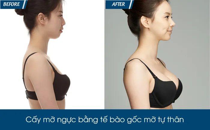 Xem Hình Ảnh Thực Tế Nâng Ngực Của Chị Em Trước Sau Phẫu Thuật