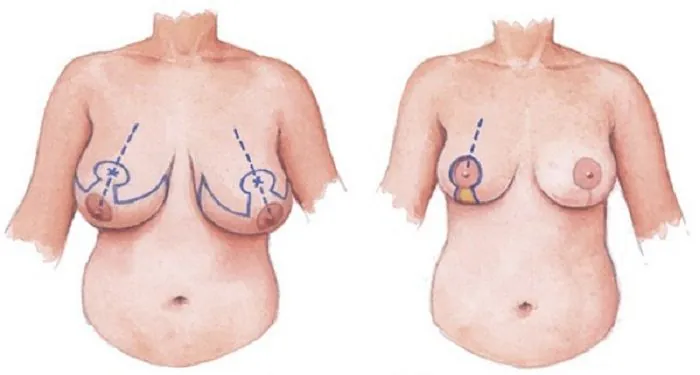 Xem Hình Ảnh Thực Tế Nâng Ngực Của Chị Em Trước Sau Phẫu Thuật