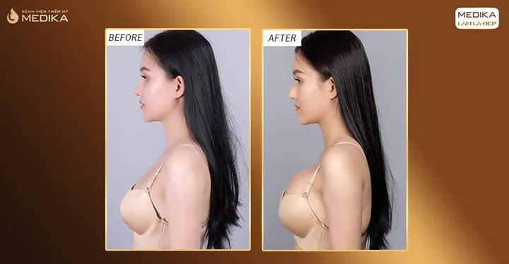Xem Hình Ảnh Thực Tế Nâng Ngực Của Chị Em Trước Sau Phẫu Thuật
