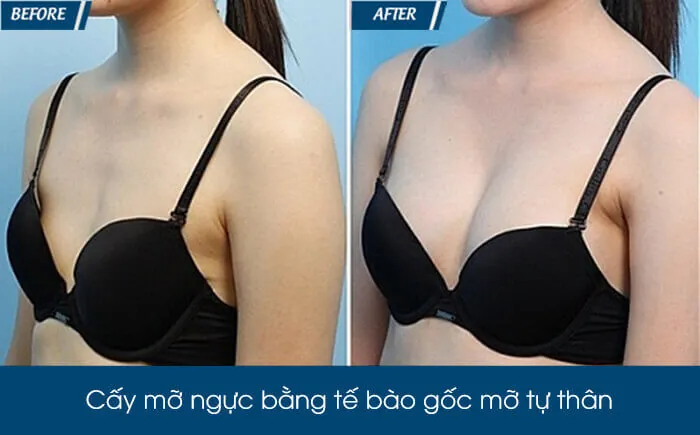 Xem Hình Ảnh Thực Tế Nâng Ngực Của Chị Em Trước Sau Phẫu Thuật