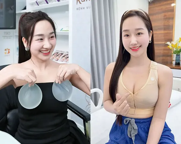 Xem Hình Ảnh Thực Tế Nâng Ngực Của Chị Em Trước Sau Phẫu Thuật