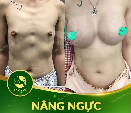 Xem Hình Ảnh Thực Tế Nâng Ngực Của Chị Em Trước Sau Phẫu Thuật