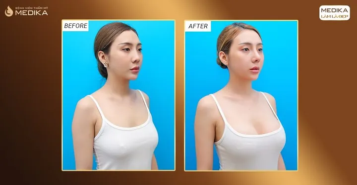 Xem Hình Ảnh Thực Tế Nâng Ngực Của Chị Em Trước Sau Phẫu Thuật