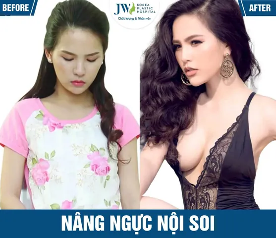 Xem Hình Ảnh Thực Tế Nâng Ngực Của Chị Em Trước Sau Phẫu Thuật
