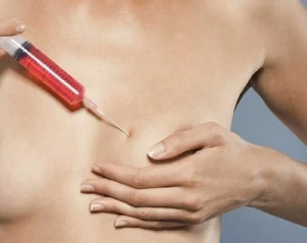 Xem Hình Ảnh Thực Tế Nâng Ngực Của Chị Em Trước Sau Phẫu Thuật