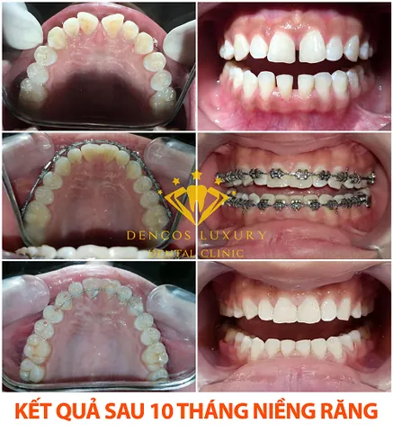 Xem Hình Ảnh Nẹp Răng Trước Và Sau Thực Tế Cho Người Đang Tìm Hiểu Xem Hình Ảnh Nẹp Răng Trước Và Sau Thực Tế Cho Người Đang Tìm Hiểu