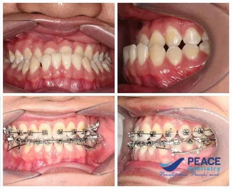Xem Hình Ảnh Nẹp Răng Trước Và Sau Thực Tế Cho Người Đang Tìm Hiểu Xem Hình Ảnh Nẹp Răng Trước Và Sau Thực Tế Cho Người Đang Tìm Hiểu