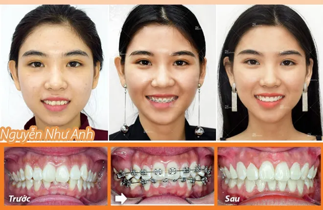 Xem Hình Ảnh Nẹp Răng Trước Và Sau Thực Tế Cho Người Đang Tìm Hiểu Xem Hình Ảnh Nẹp Răng Trước Và Sau Thực Tế Cho Người Đang Tìm Hiểu