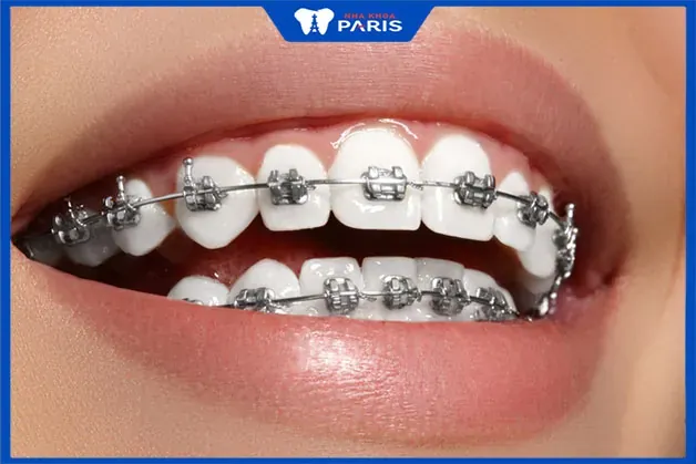 Xem Hình Ảnh Nẹp Răng Trước Và Sau Thực Tế Cho Người Đang Tìm Hiểu Xem Hình Ảnh Nẹp Răng Trước Và Sau Thực Tế Cho Người Đang Tìm Hiểu