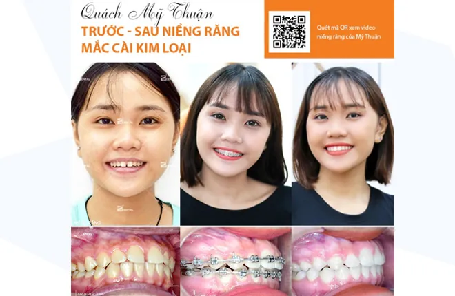 Xem Hình Ảnh Nẹp Răng Trước Và Sau Thực Tế Cho Người Đang Tìm Hiểu Xem Hình Ảnh Nẹp Răng Trước Và Sau Thực Tế Cho Người Đang Tìm Hiểu