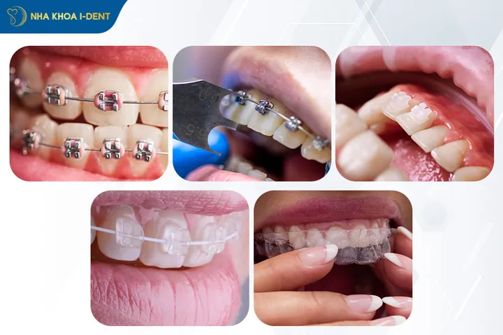 Xem Hình Ảnh Nẹp Răng Trước Và Sau Thực Tế Cho Người Đang Tìm Hiểu Xem Hình Ảnh Nẹp Răng Trước Và Sau Thực Tế Cho Người Đang Tìm Hiểu