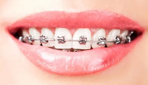 Xem Hình Ảnh Nẹp Răng Trước Và Sau Thực Tế Cho Người Đang Tìm Hiểu Xem Hình Ảnh Nẹp Răng Trước Và Sau Thực Tế Cho Người Đang Tìm Hiểu