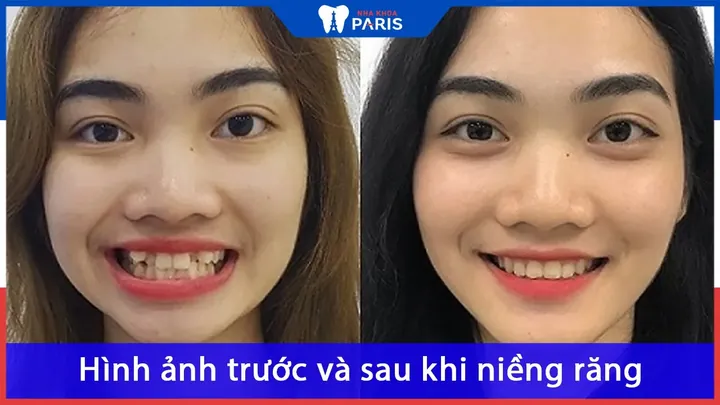 Xem Hình Ảnh Nẹp Răng Trước Và Sau Thực Tế Cho Người Đang Tìm Hiểu Xem Hình Ảnh Nẹp Răng Trước Và Sau Thực Tế Cho Người Đang Tìm Hiểu