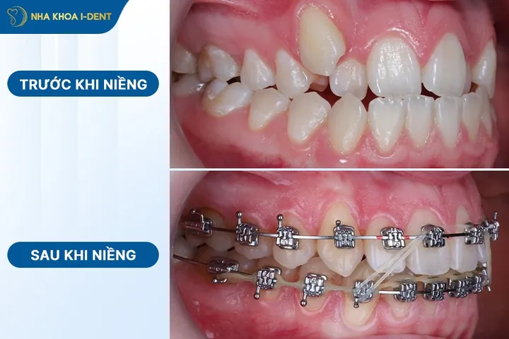 Xem Hình Ảnh Nẹp Răng Trước Và Sau Thực Tế Cho Người Đang Tìm Hiểu Xem Hình Ảnh Nẹp Răng Trước Và Sau Thực Tế Cho Người Đang Tìm Hiểu