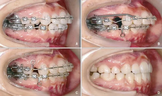 Xem Hình Ảnh Nẹp Răng Trước Và Sau Thực Tế Cho Người Đang Tìm Hiểu Xem Hình Ảnh Nẹp Răng Trước Và Sau Thực Tế Cho Người Đang Tìm Hiểu