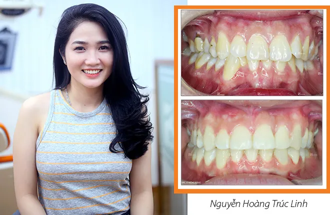 Xem Hình Ảnh Nẹp Răng Trước Và Sau Thực Tế Cho Người Đang Tìm Hiểu Xem Hình Ảnh Nẹp Răng Trước Và Sau Thực Tế Cho Người Đang Tìm Hiểu