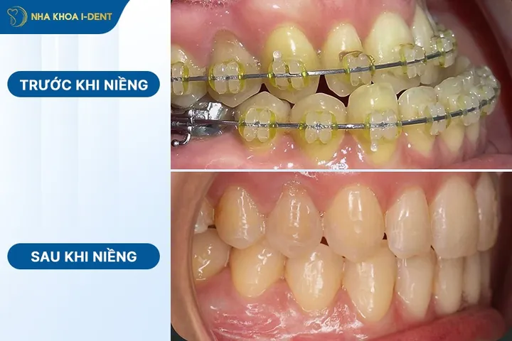 Xem Hình Ảnh Nẹp Răng Trước Và Sau Thực Tế Cho Người Đang Tìm Hiểu Xem Hình Ảnh Nẹp Răng Trước Và Sau Thực Tế Cho Người Đang Tìm Hiểu