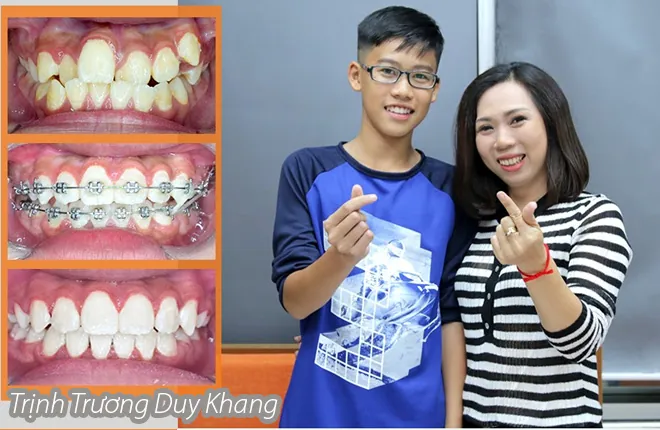 Xem Hình Ảnh Nẹp Răng Trước Và Sau Thực Tế Cho Người Đang Tìm Hiểu Xem Hình Ảnh Nẹp Răng Trước Và Sau Thực Tế Cho Người Đang Tìm Hiểu