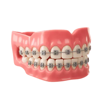 Xem Hình Ảnh Nẹp Răng Trước Và Sau Thực Tế Cho Người Đang Tìm Hiểu Xem Hình Ảnh Nẹp Răng Trước Và Sau Thực Tế Cho Người Đang Tìm Hiểu