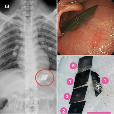 Xem Hình Ảnh Ngáo Đá Và Biểu Hiện Điển Hình Dành Cho Gia Đình Xem Hình Ảnh Ngáo Đá Và Biểu Hiện Điển Hình Dành Cho Gia Đình