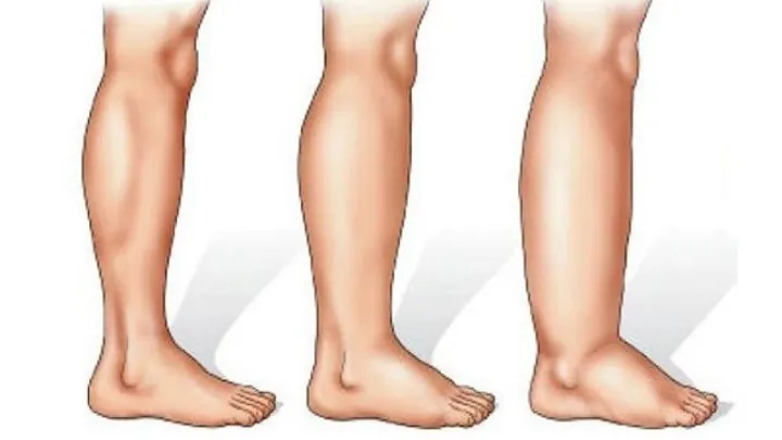 Xem Hình Ảnh Phù Mạch Và Nhận Diện Dấu Hiệu Trực Quan Cho Người Bệnh: Phân Biệt Với Mày Đay Xem Hình Ảnh Phù Mạch Và Nhận Diện Dấu Hiệu Trực Quan Cho Người Bệnh: Phân Biệt Với Mày Đay