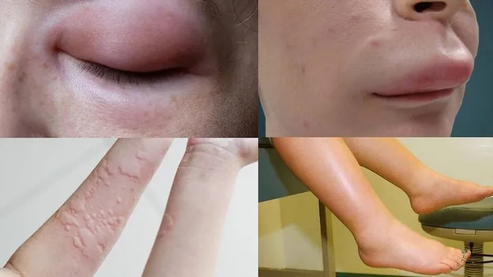 Xem Hình Ảnh Phù Mạch Và Nhận Diện Dấu Hiệu Trực Quan Cho Người Bệnh: Phân Biệt Với Mày Đay Xem Hình Ảnh Phù Mạch Và Nhận Diện Dấu Hiệu Trực Quan Cho Người Bệnh: Phân Biệt Với Mày Đay
