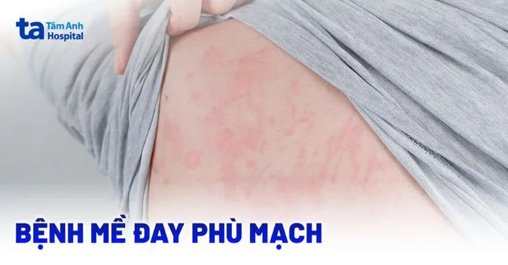 Xem Hình Ảnh Phù Mạch Và Nhận Diện Dấu Hiệu Trực Quan Cho Người Bệnh: Phân Biệt Với Mày Đay Xem Hình Ảnh Phù Mạch Và Nhận Diện Dấu Hiệu Trực Quan Cho Người Bệnh: Phân Biệt Với Mày Đay