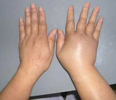 Xem Hình Ảnh Phù Mạch Và Nhận Diện Dấu Hiệu Trực Quan Cho Người Bệnh: Phân Biệt Với Mày Đay Xem Hình Ảnh Phù Mạch Và Nhận Diện Dấu Hiệu Trực Quan Cho Người Bệnh: Phân Biệt Với Mày Đay