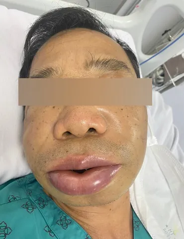 Xem Hình Ảnh Phù Mạch Và Nhận Diện Dấu Hiệu Trực Quan Cho Người Bệnh: Phân Biệt Với Mày Đay Xem Hình Ảnh Phù Mạch Và Nhận Diện Dấu Hiệu Trực Quan Cho Người Bệnh: Phân Biệt Với Mày Đay