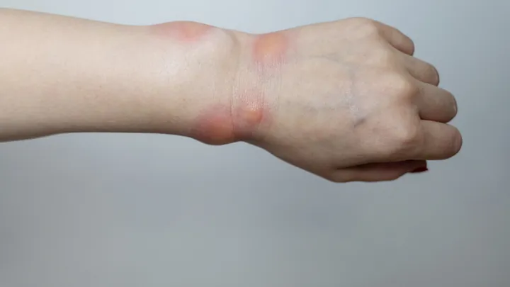 Xem Hình Ảnh Phù Mạch Và Nhận Diện Dấu Hiệu Trực Quan Cho Người Bệnh: Phân Biệt Với Mày Đay Xem Hình Ảnh Phù Mạch Và Nhận Diện Dấu Hiệu Trực Quan Cho Người Bệnh: Phân Biệt Với Mày Đay
