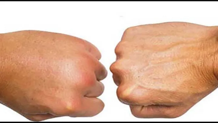 Xem Hình Ảnh Phù Mạch Và Nhận Diện Dấu Hiệu Trực Quan Cho Người Bệnh: Phân Biệt Với Mày Đay Xem Hình Ảnh Phù Mạch Và Nhận Diện Dấu Hiệu Trực Quan Cho Người Bệnh: Phân Biệt Với Mày Đay