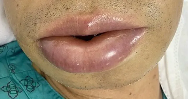 Xem Hình Ảnh Phù Mạch Và Nhận Diện Dấu Hiệu Trực Quan Cho Người Bệnh: Phân Biệt Với Mày Đay Xem Hình Ảnh Phù Mạch Và Nhận Diện Dấu Hiệu Trực Quan Cho Người Bệnh: Phân Biệt Với Mày Đay