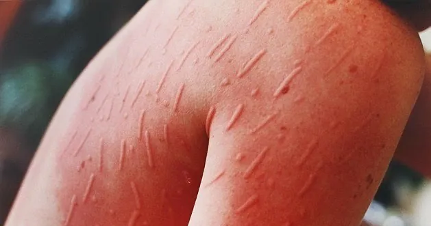 Xem Hình Ảnh Phù Mạch Và Nhận Diện Dấu Hiệu Trực Quan Cho Người Bệnh: Phân Biệt Với Mày Đay Xem Hình Ảnh Phù Mạch Và Nhận Diện Dấu Hiệu Trực Quan Cho Người Bệnh: Phân Biệt Với Mày Đay